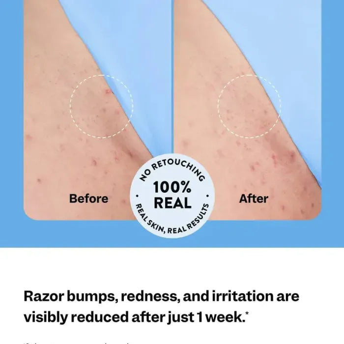 Ingrown Hair Treament